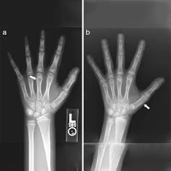 What Is The Role Of X-Rays In Bone Age Study?